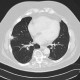 Lung infarction, development in time, follow-up: CT - Computed tomography